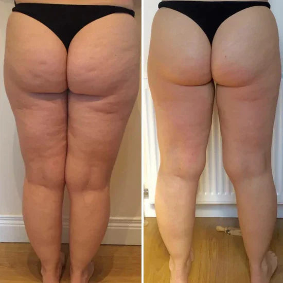 Anti-Cellulite Massager