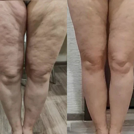 Anti-Cellulite Suction Cup