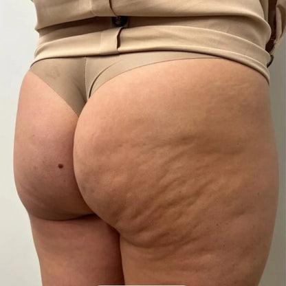 Anti-Cellulite Massager