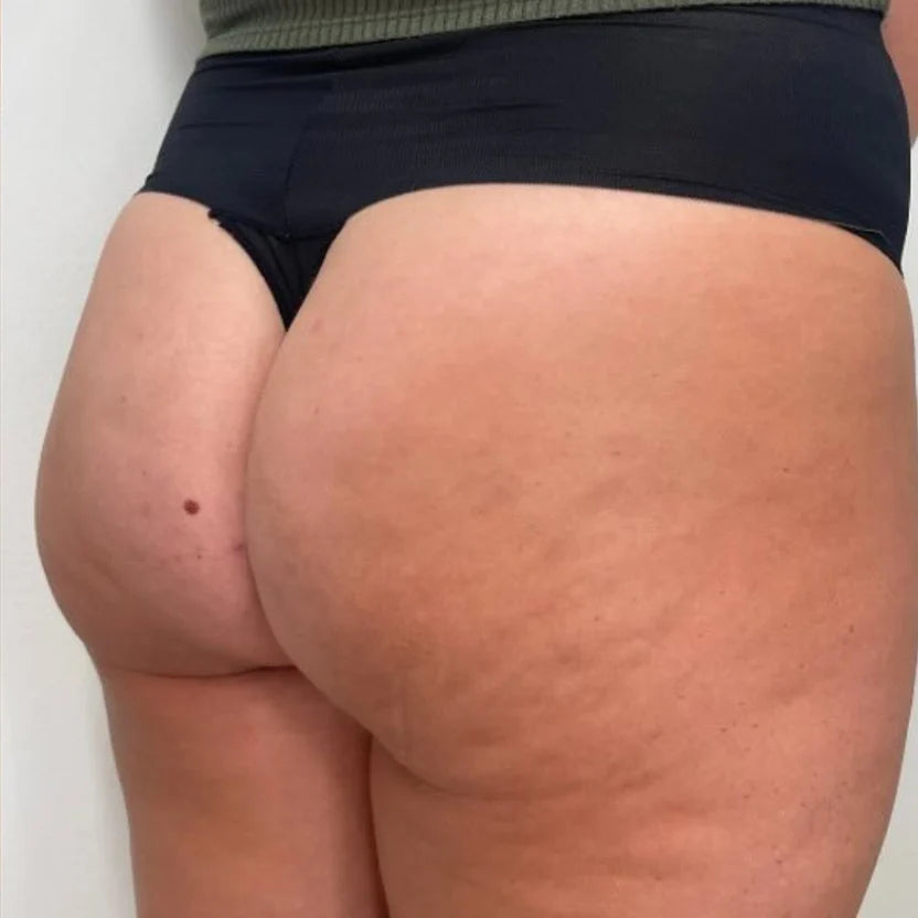 Anti-Cellulite Massager