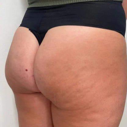 Anti-Cellulite Massager